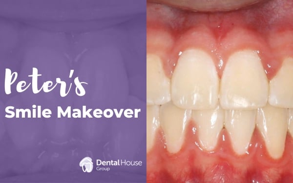 Peter of Melbourne’s Fixed Braces Journey in Greenvale Dental House