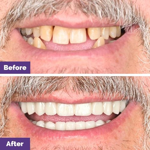 David Of Sunbury’s All On 4 Plus® Smile Makeover In Dental House David Of Sunbury's All On 4 Plus® Smile Makeover In Dental House