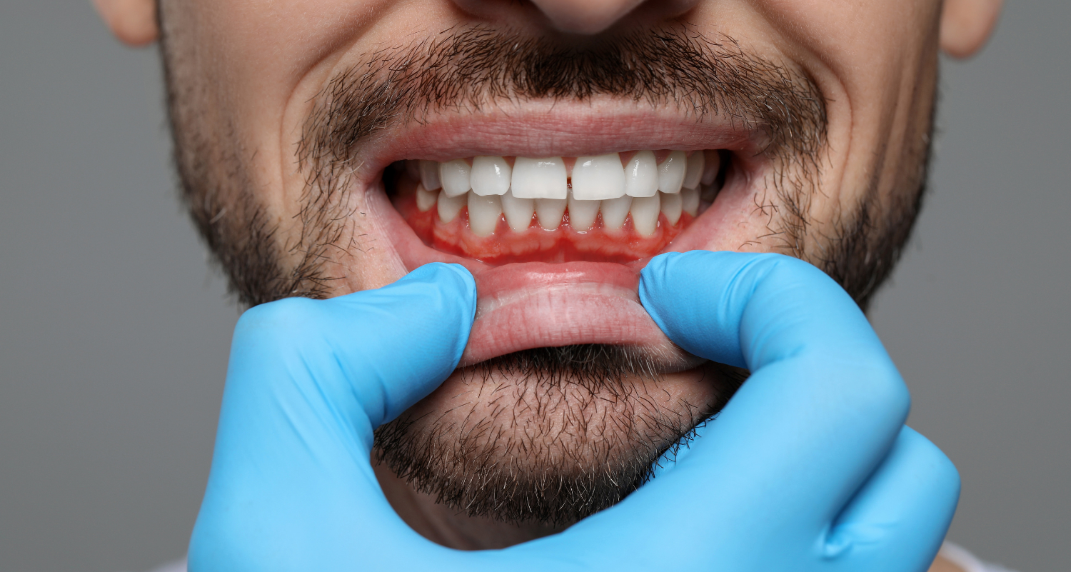 Wonky Gum Lines Got You Down? Here’s How We Can Fix Them