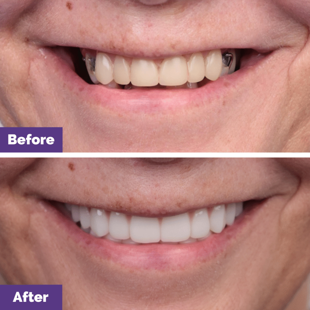 Jacky's All On 4 Plus Journey In Dental House