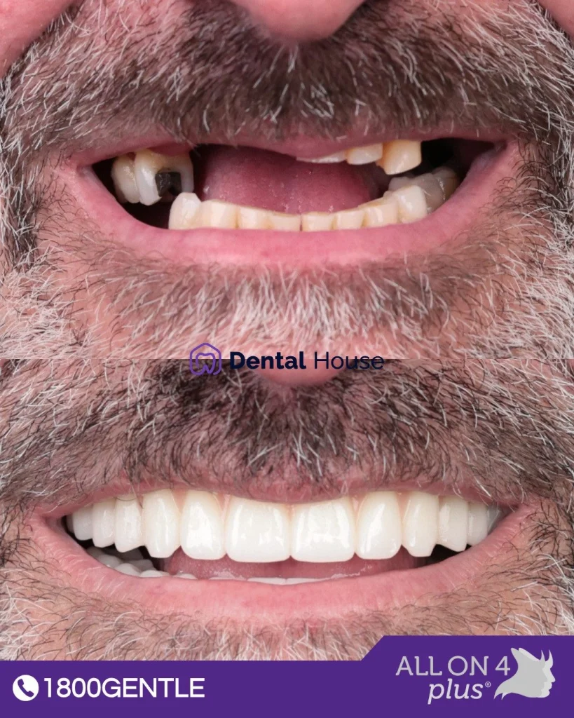 All On Plus® at Greenvale Dental House in Greenvale, Craigieburn, Roxburgh Park, and Melbourne