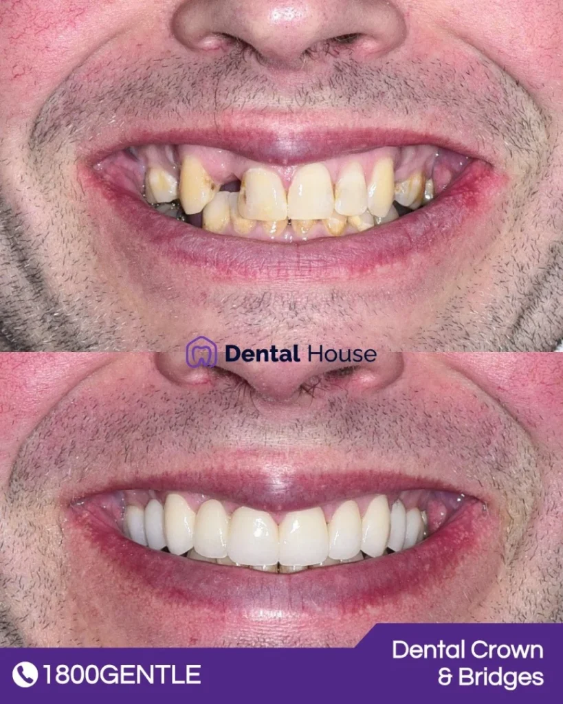 Dental Crown and Bridges at Greenvale Dental House in Greenvale, Craigieburn, Roxburgh Park, and Melbourne