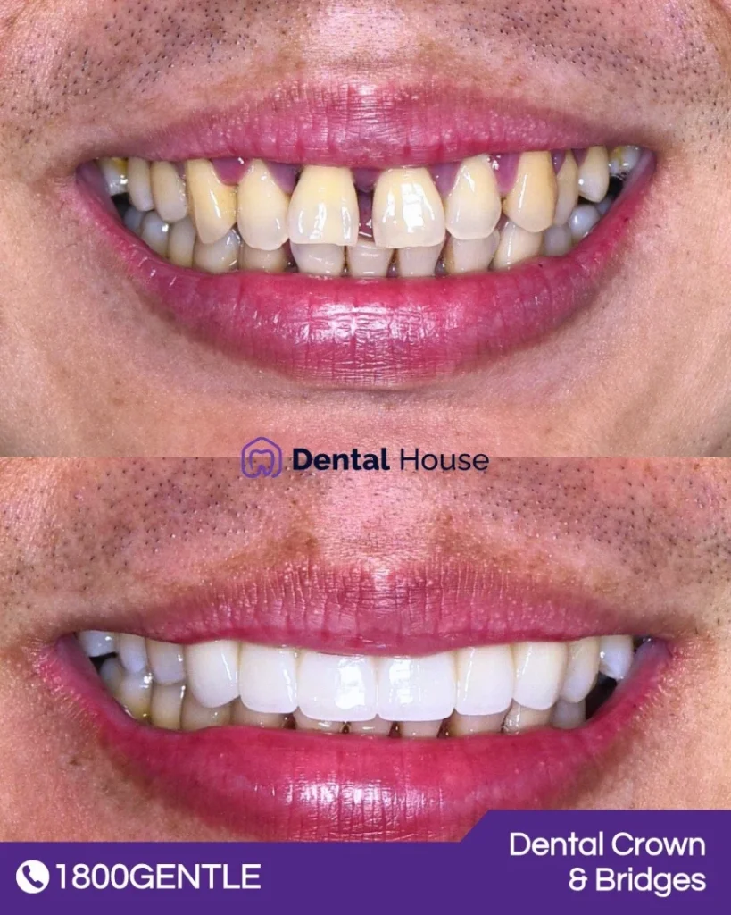 Dental Crown and Bridges at Greenvale Dental House in Greenvale, Craigieburn, Roxburgh Park, and Melbourne
