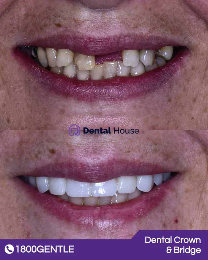 Dental Bridge at Greenvale Dental House in Greenvale, Craigieburn, Roxburgh Park, and Melbourne