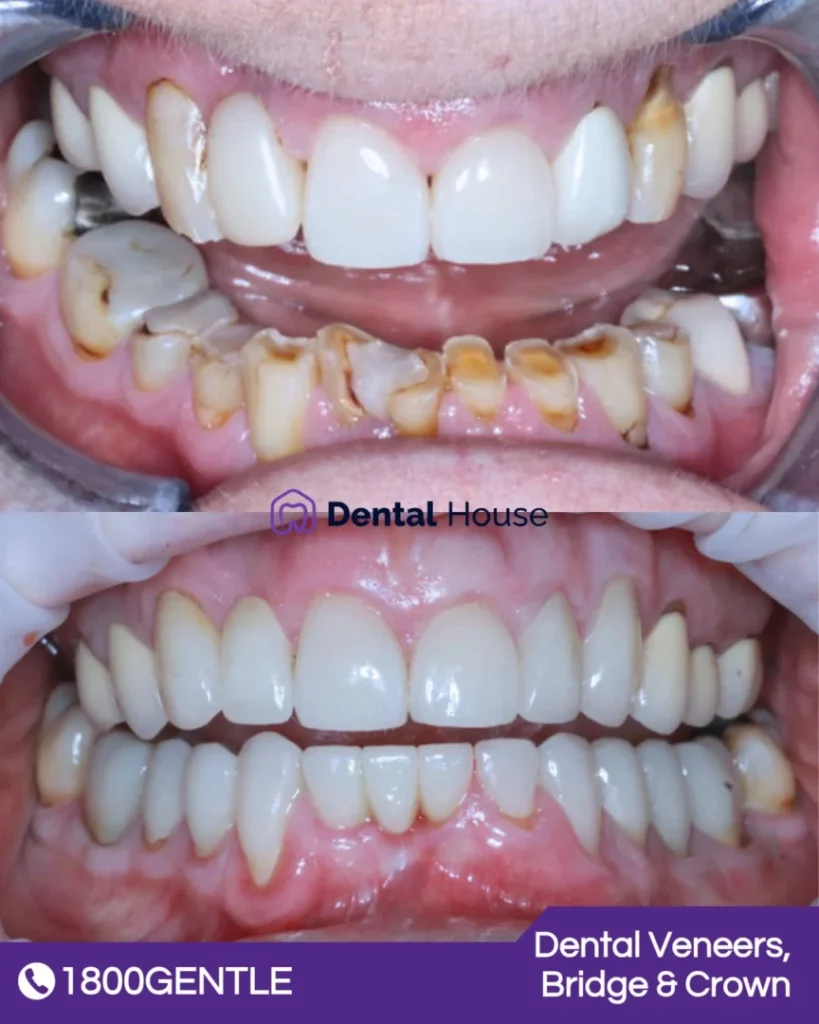 Dental Bridge at Greenvale Dental House in Greenvale, Craigieburn, Roxburgh Park, and Melbourne