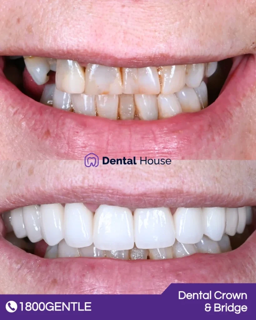 Dental Bridge at Greenvale Dental House in Greenvale, Craigieburn, Roxburgh Park, and Melbourne