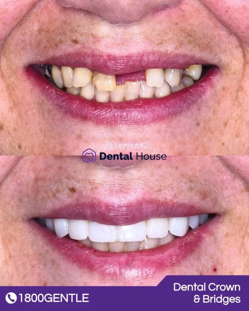 Dental Crown and Bridges at Greenvale Dental House in Greenvale, Craigieburn, Roxburgh Park, and Melbourne