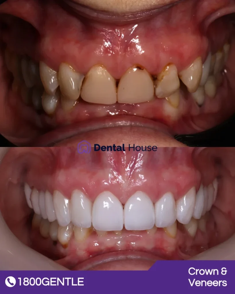 Porcelain Veneers at Greenvale Dental House in Greenvale, Craigieburn, Roxburgh Park, and Melbourne