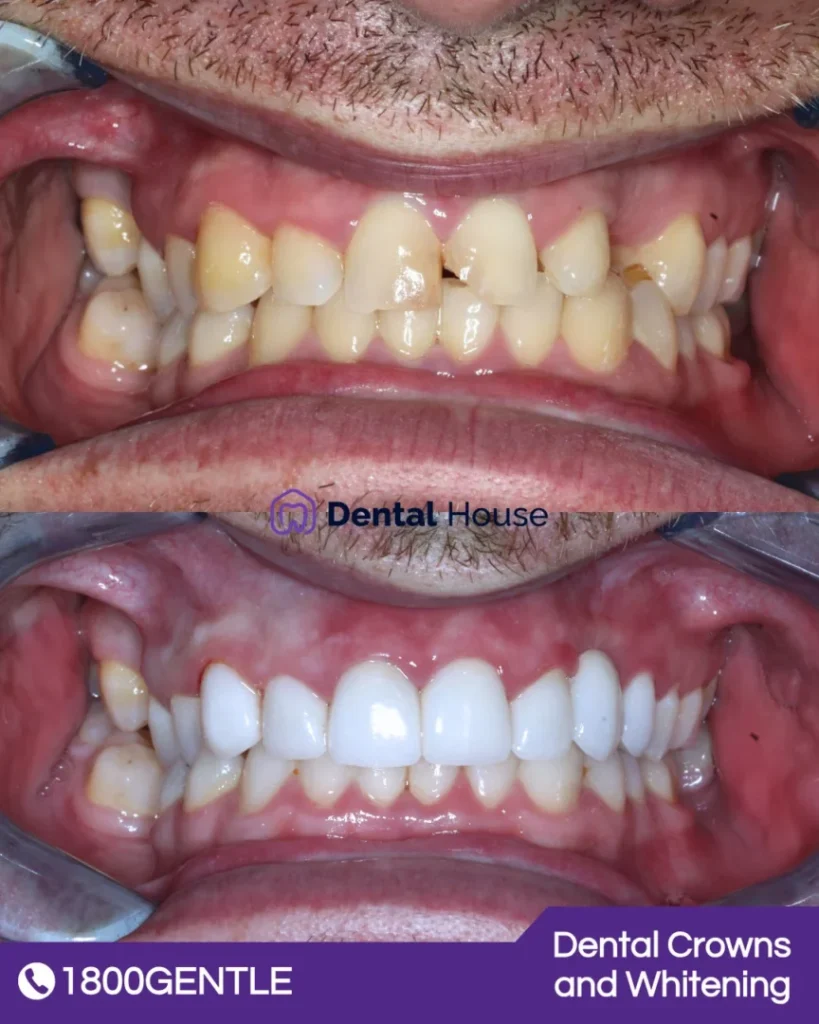 Dental Crowns and Whitening at Greenvale Dental House in Greenvale, Craigieburn, Roxburgh Park, and Melbourne