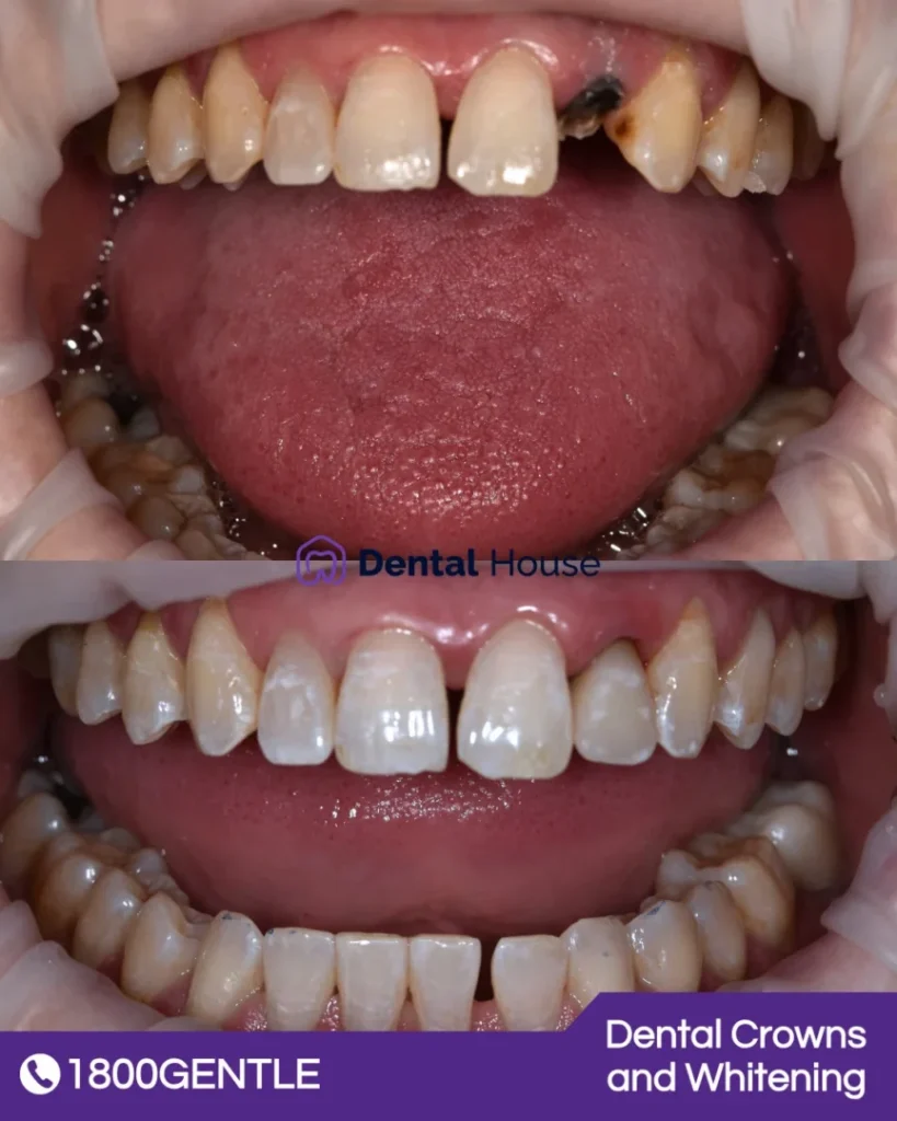 Dental Crowns and Whitening at Greenvale Dental House in Greenvale, Craigieburn, Roxburgh Park, and Melbourne