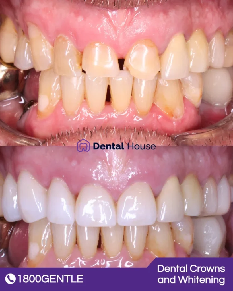 Dental Crowns and Whitening at Greenvale Dental House in Greenvale, Craigieburn, Roxburgh Park, and Melbourne