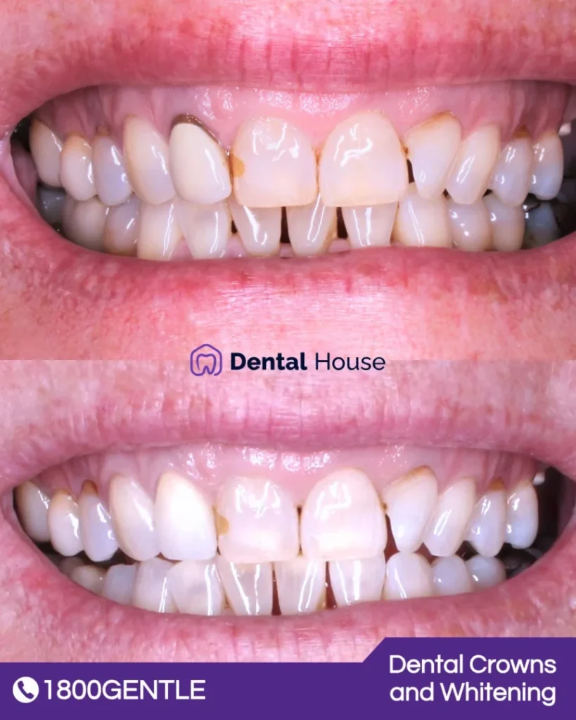 Dental Crowns and Whitening at Greenvale Dental House in Greenvale, Craigieburn, Roxburgh Park, and Melbourne