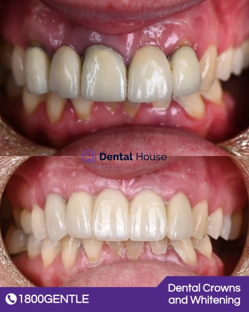 Dental Crowns and Whitening at Greenvale Dental House in Greenvale, Craigieburn, Roxburgh Park, and Melbourne