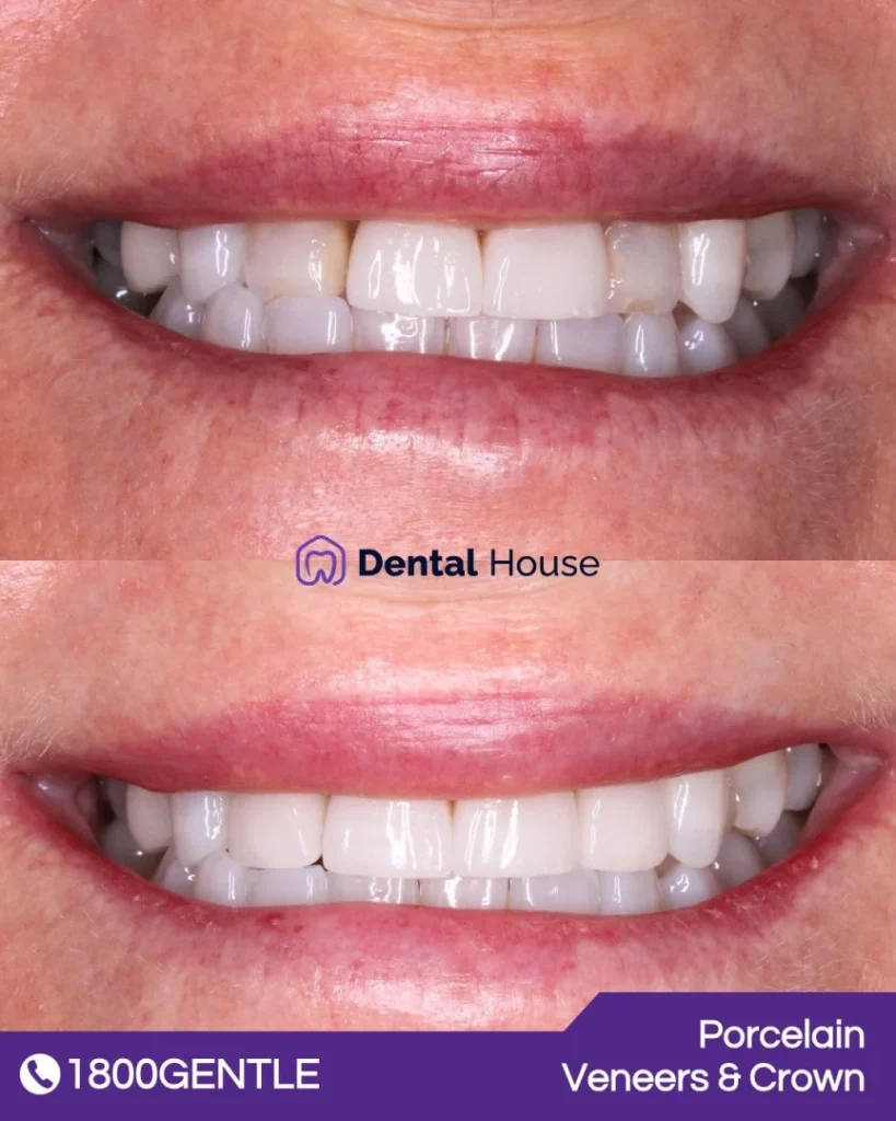 Porcelain Veneers at Greenvale Dental House in Greenvale, Craigieburn, Roxburgh Park, and Melbourne