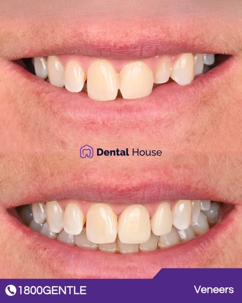 Porcelain Veneers at Greenvale Dental House in Greenvale, Craigieburn, Roxburgh Park, and Melbourne
