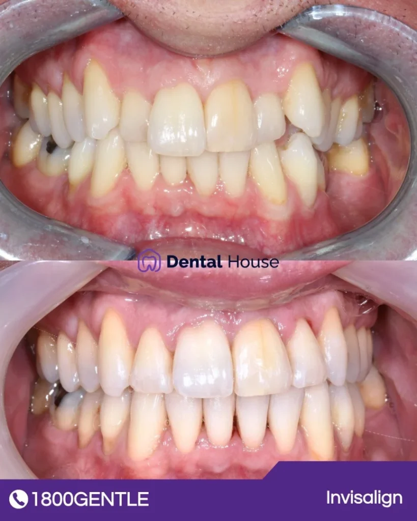 Invisalign at Greenvale Dental House in Greenvale, Craigieburn, Roxburgh Park, and Melbourne