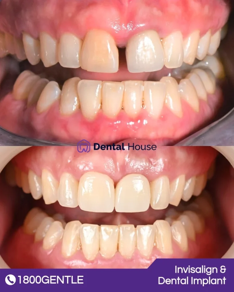 Invisalign at Greenvale Dental House in Greenvale, Craigieburn, Roxburgh Park, and Melbourne