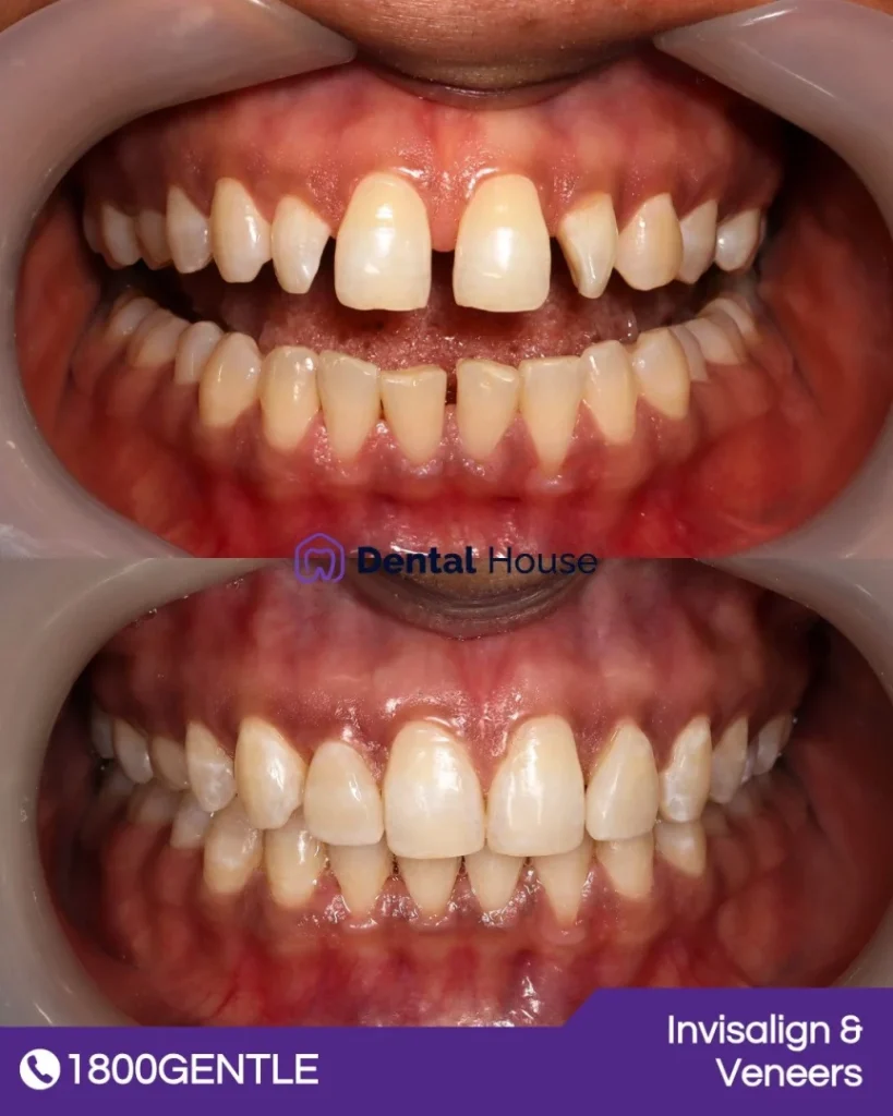 Invisalign at Greenvale Dental House in Greenvale, Craigieburn, Roxburgh Park, and Melbourne
