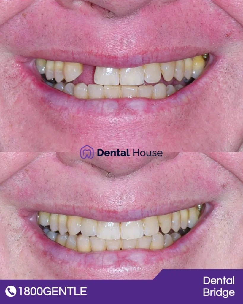 Dental Bridge at Greenvale Dental House in Greenvale, Craigieburn, Roxburgh Park, and Melbourne