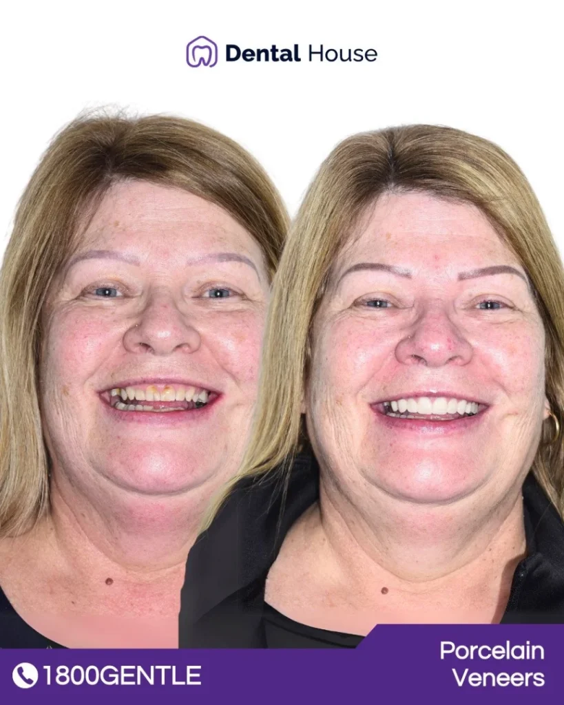 Porcelain Veneers at Greenvale Dental House in Greenvale, Craigieburn, Roxburgh Park, and Melbourne
