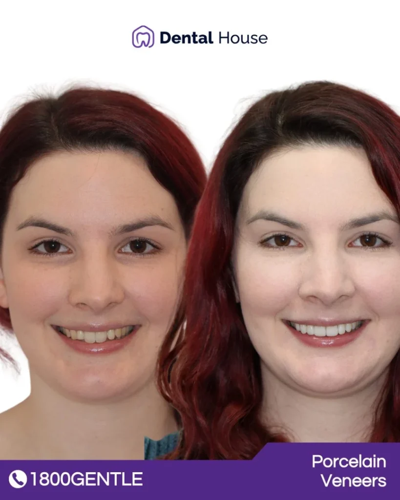 Porcelain Veneers at Greenvale Dental House in Greenvale, Craigieburn, Roxburgh Park, and Melbourne