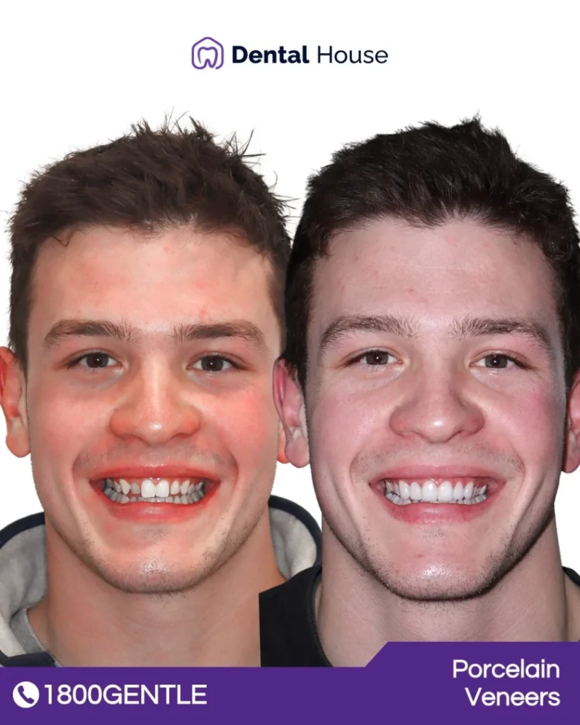 Porcelain Veneers at Greenvale Dental House in Greenvale, Craigieburn, Roxburgh Park, and Melbourne