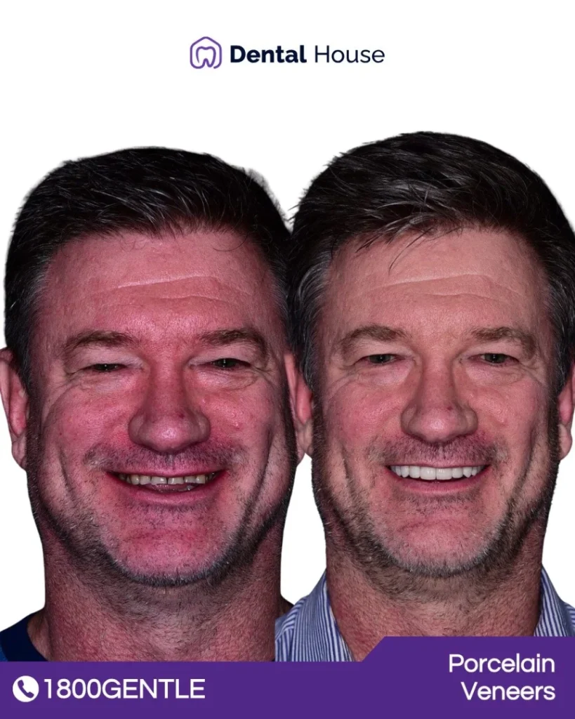 Porcelain Veneers at Greenvale Dental House in Greenvale, Craigieburn, Roxburgh Park, and Melbourne