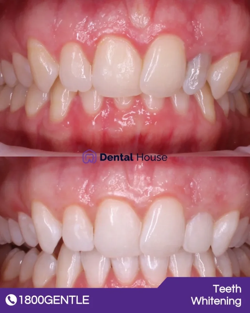 Invisalign & Teeth Whitening at Greenvale Dental House in Greenvale, Craigieburn, Roxburgh Park, and Melbourne