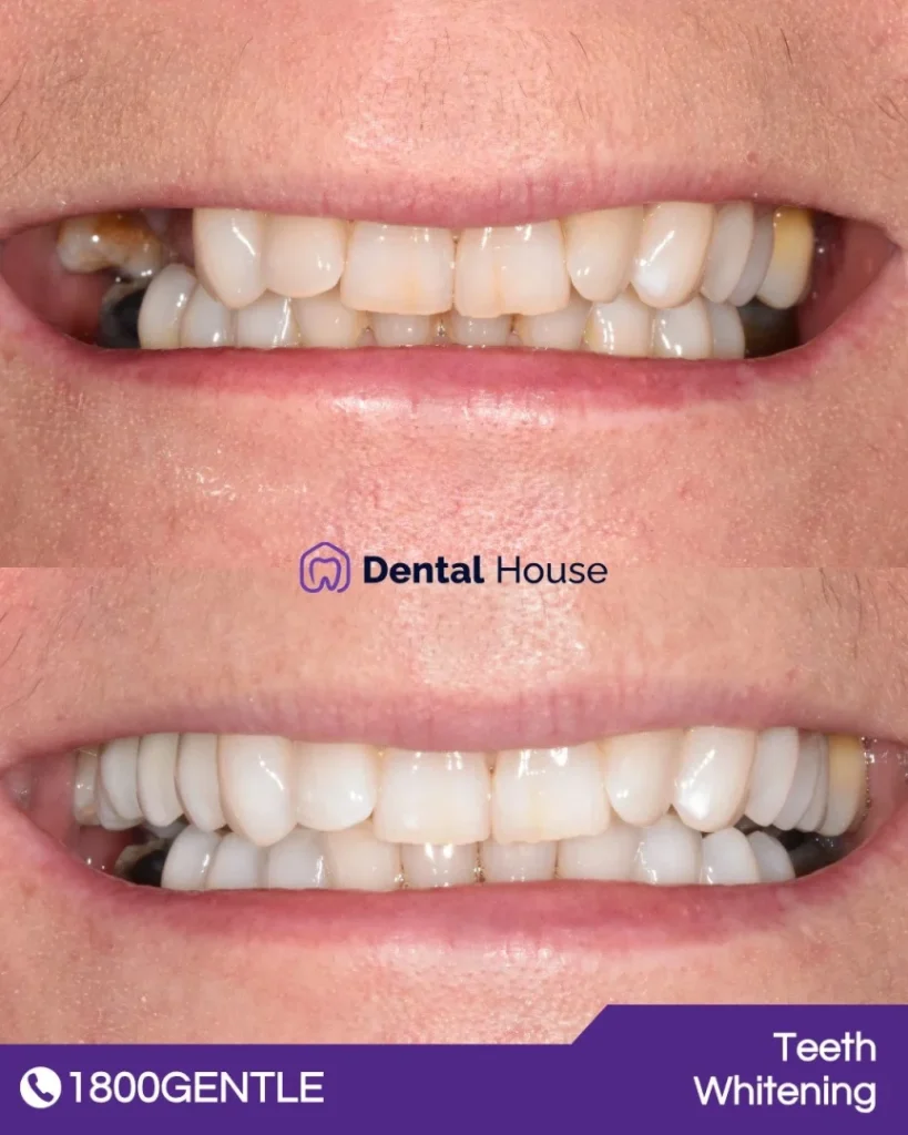 Teeth Whitening & Dental Implant at Greenvale Dental House in Greenvale, Craigieburn, Roxburgh Park, and Melbourne