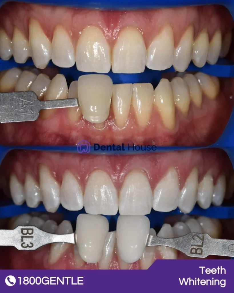 Teeth Whitening at Greenvale Dental House in Greenvale, Craigieburn, Roxburgh Park, and Melbourne