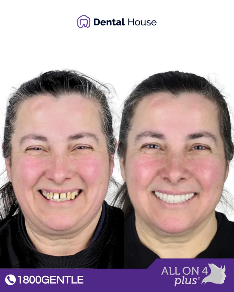 Before and after dental transformation